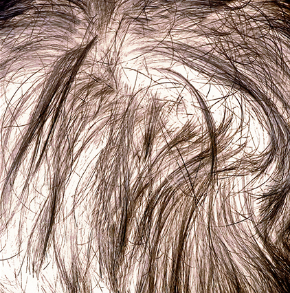 Hair Scalp Haarausfall Lösung Zweithaar 